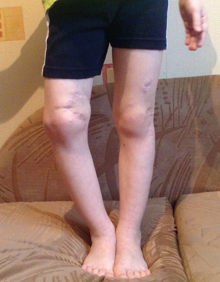 Пятилетний Клим готовится к очередной операции для восстановления ног после осколочного ранения