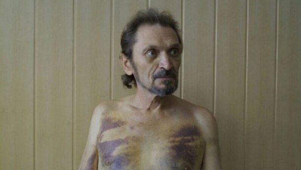 Олександр Хомченко після звільнення з полону бойовиків/фото з відкритих джерел